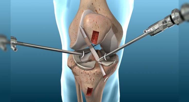 knee Arthroscopy Specialist in New Rajendra Nagar